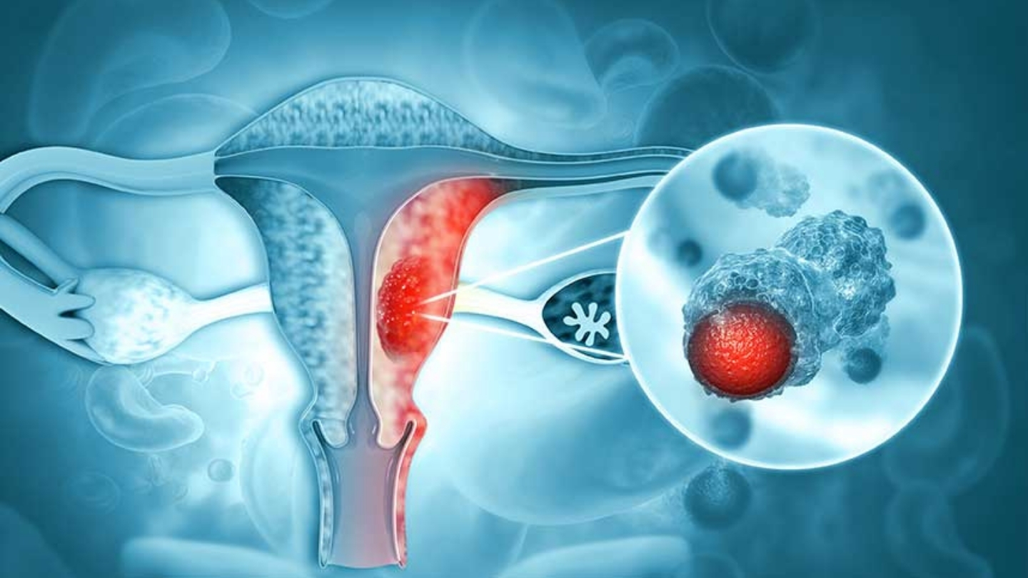 İzmir Hpv Tedavisi